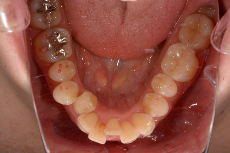 インビザラインの術前の下の歯