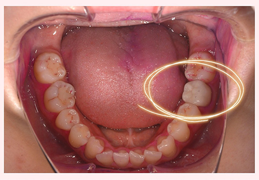 根幹処置歯における根尖部X線透過象の発現率